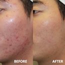 최동준 | [신사역 남자 전문 피부과] 남자 제모와 여드름 케어, 한번에 해결해야 하는 이유