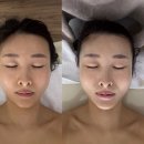 [의정부 피부관리] 스킨포유 의정부점 카복시테라피 후기 (모공, 미백, 트러블 개선)