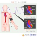 고혈압의 정의, 증상, 합병증, 치료법 이미지