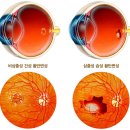 황반변성 (Macular Degeneration) 원인 및 증상, 치료방법 이미지