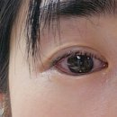 미란네 | 아침마다 눈 뜨는 게 공포였던 이유… [재발성 각막미란] 후기 😭👁️🥲
