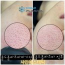 파리바게뜨 하양무학점 | [샤인에스테틱 경산하양점] 모공 줄이기 ∥ 경산 피부관리 콜드 플라즈마 솔직후기 (사진, 가격, 효과...