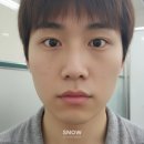 이노스이비인후과병원 | 편도절제술 후기