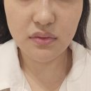 유니버스 | 웨딩촬영 전 예신이 해야하는 관리 안양역 한의원 슈링크 유니버스 솔직 후기