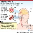 뇌졸중 이미지