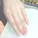 수지침(야간) 이미지