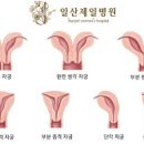 쌍각자궁 임신 출산 다 가능해요 도움이 되는 정보는 이미지
