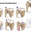 견쇄관절 분리/탈구 (Acromioclavicular Joint Separation/Dislocation) 이미지