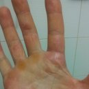 스테로이드(반동현상)선이 이미지