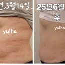 라라앤코스매틱 | 3개월 만에 복부라인 정리 끝!