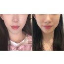 프라임약국 | 압구정피부과 울쎄라프라임 내돈내산 후기