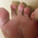 메디원스 | 발가락 수포형 무좀약 한번 바르는 바르지오원스 후기