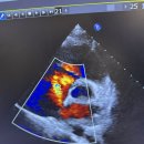 비투PC | 서울아산병원 심방중격결손 시술후기 강덕현 교수님