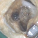 나노치과보존과치과의원 | [나노치과보존과]“근관 내 파일 파절, 현미경으로 제거하고 재신경 치료한 사례”