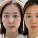 논현아이성형외과의원 | 아몬드성형외과논현점 심승현원장님 울쎄라피프라임...심부볼 리프팅 이중턱 시술(후기 통증 가격 효과)