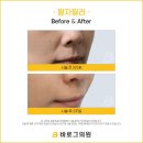 미건의료기 서면지점 | 서면피부과추천, 팔자필러 이것 모르면 깊어져요