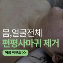 대우프라자 | [편평사마귀 제거] 얼굴·몸 전체까지! 전국에서 찾아오는 합리적인 가격,만족후기