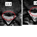 동이 님의 요추디스크 L3-4,L5-S1, 요추협착증 사진입니다. 이미지