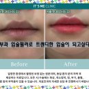 잇츠멍 | 화성피부과 입술필러로 트렌디한 입술이 되고싶다면