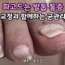 레푸스 화정점 이미지