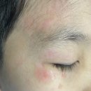 남악이비인후과의원 | 아이 얼굴 찰과상 피부 쓸림 치료후기 3주차 (ft. 손톱 거스러미 염증)