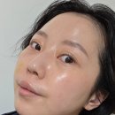 올페이스짐 | 서대문피부과 눈밑 앞볼, 쥬베룩 올페이스 4cc 시술 후기