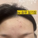 +V빔 5개월 후 추가)안산 정ㅎㄱ 피부과 여드름&amp; v빔 - 내돈내산!