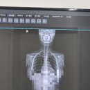 서울88의원 | 욕조에 부딪혀 갈비뼈에 금이 갔어요🦴ㅣ10번 갈비뼈 미세골절 진단 후기