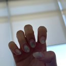 에스티성형외과의원 | 눈밑지방재배치 깔끔해져 만족중인 내돈내산 한달후기