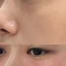 거성메디칼판매(대구지사) | 대구 플라즈마 콜드플라즈마지사 아미뷰티아카데미 눈밑꺼짐 후기