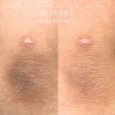 은미인뷰티케어 | 홍대 은뷰티 팔꿈치 착색 케어 후기, 여름 대비 톤 개선 제대로 한 후기