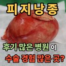 길동미래로내과의원 | 피지낭종 후기 사진 많은 병원이 수술경험 많은 곳?(천보성 외과)