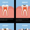 충치란 무엇인가? 이미지