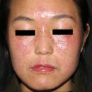 뉴로메디칼 - 강동구 천호대로 1124 | 얼굴 홍조인 줄 알았는데 모낭충증? '주사(Rosacea)'의 감별질환과 정밀 치료법