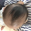 이을아이두의원 | 아기 두상 교정 헬맷 5개월 착용한 솔직한 변화 기록 – ( 아이러브헬맷 / 이을아이두의원 )