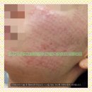 바이티에이치에스샤인 | 세종시리쥬란힐러 손주사 VS 기계주사 어떤 걸 선택해야 할까?