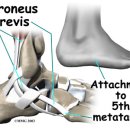 제5중족골 기저부 골절 (Fractures of the Fifth Metatarsal Base) 이미지