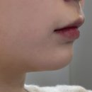 라임 | [청담피부과] 울쎄라 피프라임 내돈내산 후기 얼굴선 솔직 변화 기록