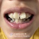 미니쉬치과병원 인비절라인 치아교정 1년차 후기