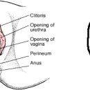 인공도뇨 / 단순도뇨 이미지