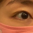 렌즈삽입술 후기 입니다 !