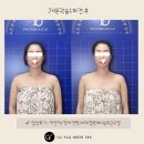 JH메디 | 칠곡 학정동 피부관리, JH윤곽술 후기 '가율메디스파'