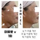 광주 수완지구 흑석동 피부관리 메디컬스킨케어 애드미엘에서 미엘로V 이중턱 집중케어를 경험해보세요!