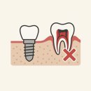 처음보다 더 | [치아관리] 20대 임플란트 실제 후기｜처음보다 더 아팠던 이유
