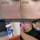 핫한 그 회사, 진짜 잘 나갈까 | 요즘 핫한 세렉소(Celexo) 시카(식물) 엑소좀 스킨부스터,실제 피부과 시술 후기