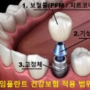임플란트의모든것
