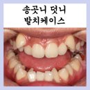 노원교정치과, &#39;이렇게&#39; 진행됩니다 &lt;전문의작성&gt;