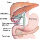 담석(담석증), 담낭염(cholecystitis)의 원인, 진단 및 치료 이미지