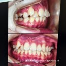 연치과의원 | 의정부 교정 연세이예쁜치과 상담 후기 (청소년 교정) 🦷