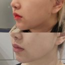 강외과의원 | 강남성형외과 턱살리프팅 민트실리프팅 후기